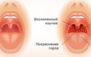 - Как вылечить ангинуКеросин--это правда? -- Форум водномоторников.